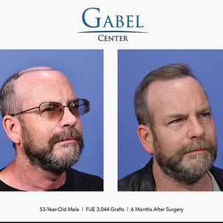 #TransformationalTuesday - A 53-year-old male patient had significant frontal hair loss at the hairl