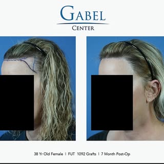 #wondrouswednesday A new day right around the corner - This patient is a 38-year-old woman who has t