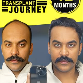 ✅ Best Hair Transplant Results: Actor Swapnil Dhondge’s Transformation Day 1 to 12 Months | Fusion A