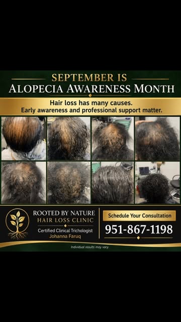 💚 September is Alopecia Awareness Month 💚

Hair loss is more than a cosmetic concern—it can affect