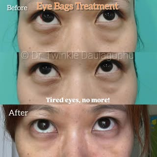 Refreshed. Rejuvenated. Radiant. That’s the power of our under-eye treatment ~ 
.
.
.
Eye Bags, unde