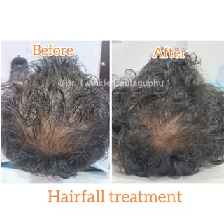 He thought hair thinning was permanent… until we reactivated his scalp with Exosomes.

These tiny me