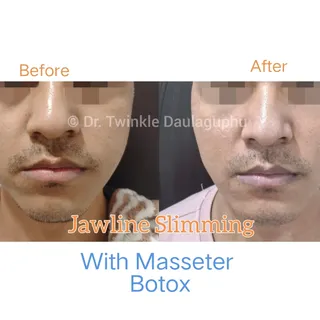 Masseter Botox for a slimmer, more contoured look~

Masseter Botox, Teeth clenching, jawline slimmin