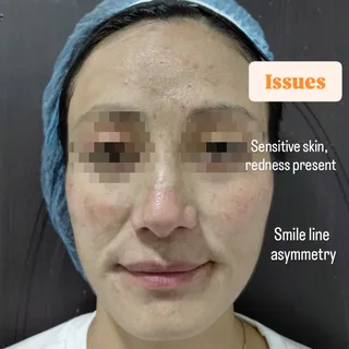 Real Results: Redness Reduced & Smile Restored. ❤️🩹

Check out this 3-month journey! We focused on 