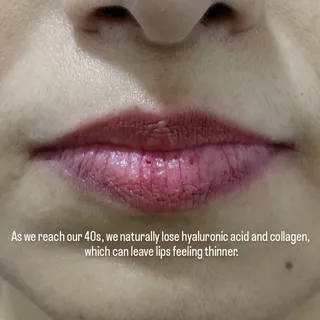 Thinning lips are a natural part of the ageing process, but they don't have to be permanent! 👄

Thi