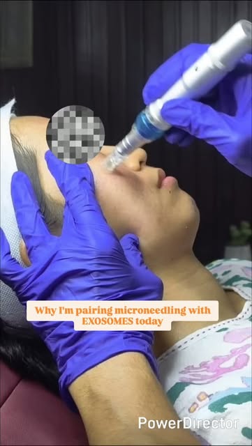 Benefits of combining microneedling with exosomes:

•Accelerated Cellular Repair: Exosomes send sign