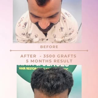 New hairline. New confidence. Just 5 months post-transplant 

#HairTransplant #HairTransplantIndia #
