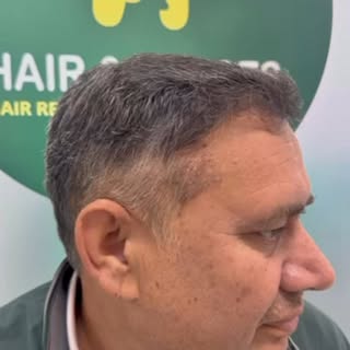 Seven months Result of Mr Danish Siddqui, Age 51 years. 3147 Hairs follicles transplanted ( scalp pl