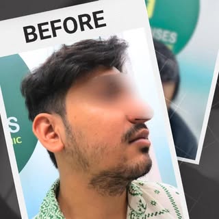 Patience, precision, and 2 years of perfect results.
 
#BeardTransplant #BeardTransformation #BeardG