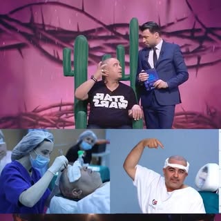 L’ artiste tunisien mohamed Bousseta 2 semaines apres sa greffe de cheveux زراعة الشعر الفنان التونس