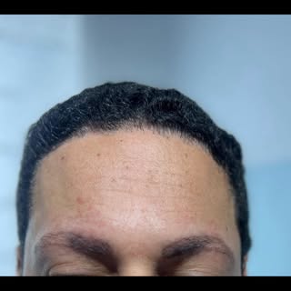 Greffe sourcils pour hommes aussi !
Queue du sourcil ou es tu ? Qui souffre de ça?