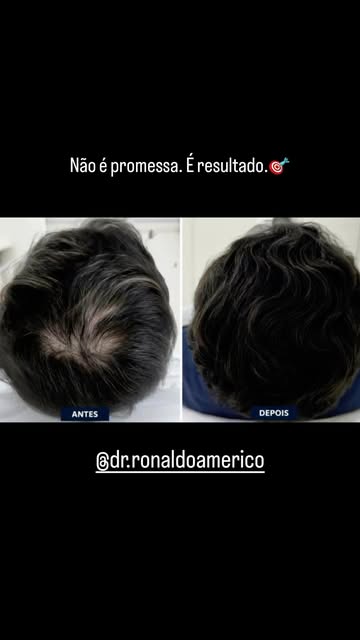 Não é promessa. É resultado.

Olha a diferença desse antes e depois. 👇

Um caso masculino que mostr