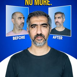 Bald! No More.

Meet Dr. Vaibhav Shah — one of Mumbai's most trusted hair transplant specialists, de