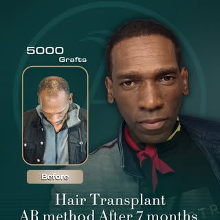 7 months after hair transplant
5000 grafts

A natural hairline, balanced density, and a result that 