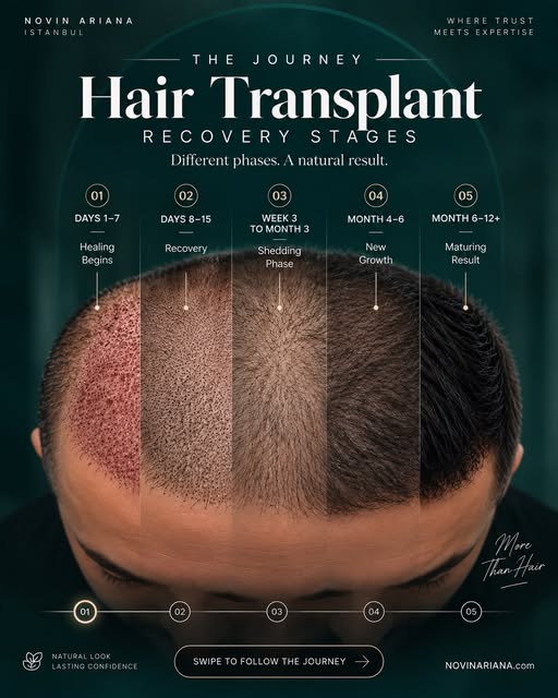 What really happens after a hair transplant? 👀

The journey doesn’t end when the procedure is over 