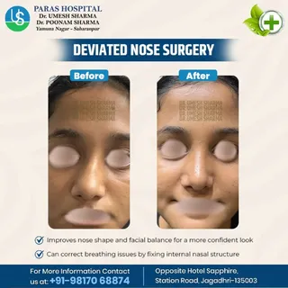 Deviated Nose Surgery (Septo-Rhinoplasty)
Breathe better. Look balanced. Feel confident ✨

This proc