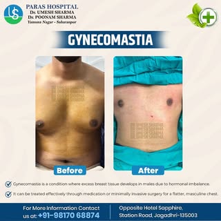 Gynecomastia: Not Just a Cosmetic Concern
It’s a medical condition—and it’s completely treatable.

W