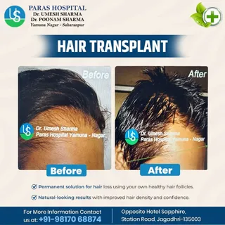 Regain Your Confidence with Advanced Hair Transplant
Permanent, natural-looking hair restoration usi