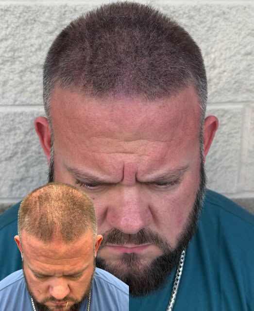 ALL WE DO IS BRING BACK CONFIDENCE!!! AND PERFECT HAIR RESTORATION!!! ✍🏼💉

THIS IS WHAT WE DO 24/7