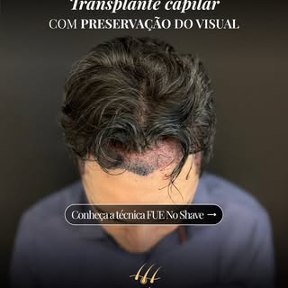 Na Belém Transplante Capilar, cada planejamento é pensado de forma individualizada, inclusive para p