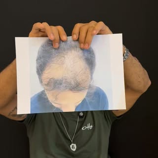 Ele olhou para essa foto e decidiu que era hora de mudar! 

Hoje, depois do transplante capilar, a h