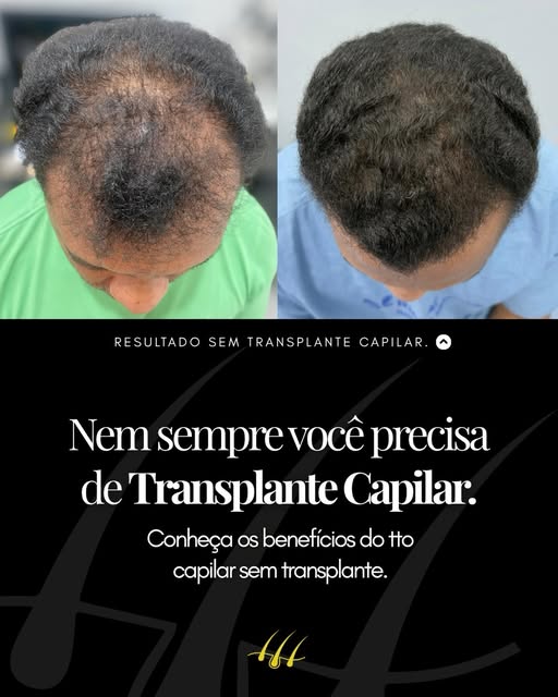 Nem sempre a queda de cabelo precisa levar diretamente a um transplante.

Em alguns casos, existem a