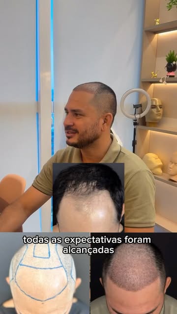 2 semanas  pós-transplante: o início de uma nova fase! 

Hoje recebemos o Elson para o acompanhament