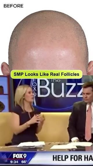 How SMP Replicates Real Hair Follicles 🧬 (FOX 9 Live Breakdown)

How does Scalp Micropigmentation a