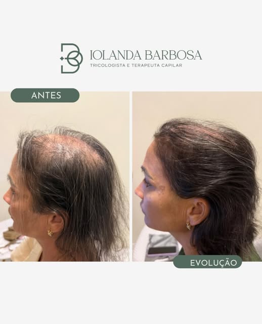 Evolução que já começa a aparecer!

Esse é um resultado parcial do tratamento, e já podemos observar