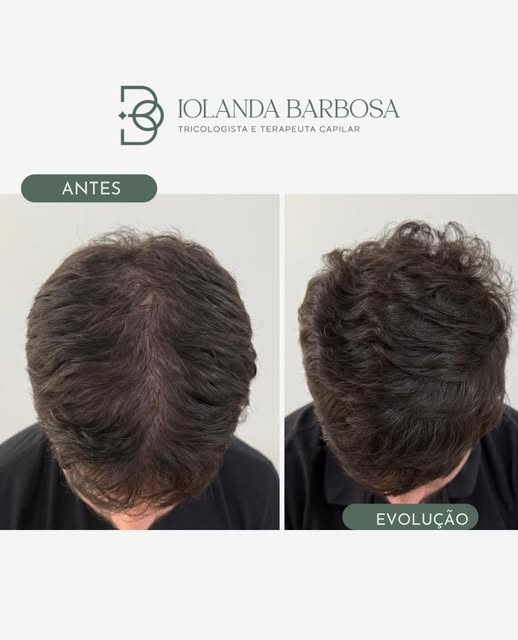 Evolução que mostra a importância da constância.

Mais densidade, mais volume e uma aparência mais p