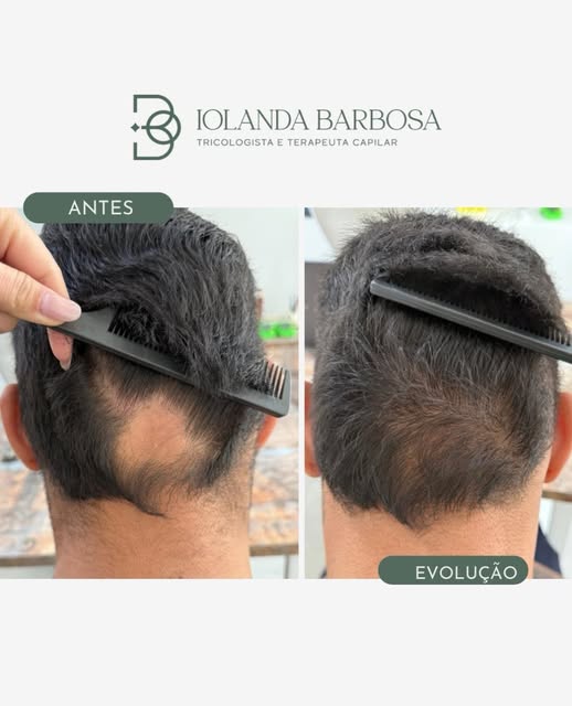 Alopecia areata | Evolução 

Um resultado ainda parcial, mas que já demonstra sinais de repilação na