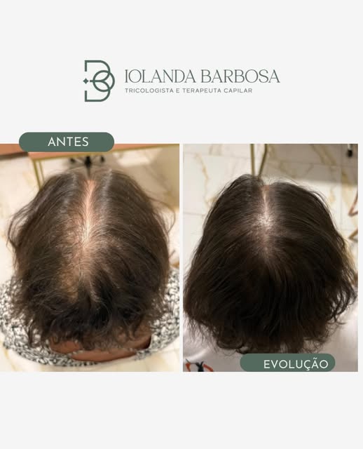 Evolução no tratamento da calvície 

Mais densidade, maior cobertura e uma evolução visível na regiã