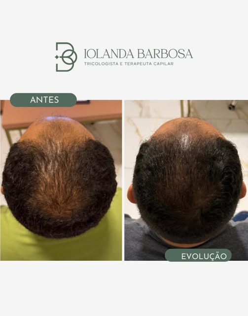 Resultado parcial de um tratamento que ainda está no início.

Mesmo em pouco tempo, já é possível ob