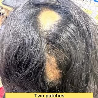 #ageraskinclinic #drpbaraniraja #pondyskindoc #hairlossclinic