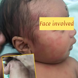 multiple generalized annular and polycyclic erythematous patches/plaques with central clearing, invo