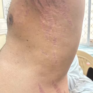 Not every stretch mark is ‘just’ a stretch mark… 👀”

A young man presented with multiple violaceous