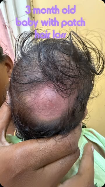 Only 3 months old—and already a scalp fungal infection? 🔬

This infant developed a red, scaly patch