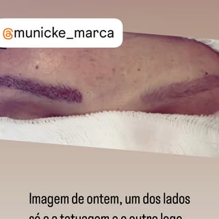 Aqui em nossa @clinicavanessamutton fazemos tx de cabelos e sobrancelhas ! Essa cg foi realizada ont