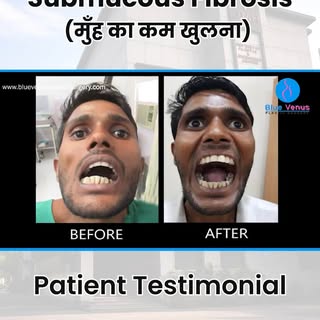 🤔 Can't Open Your Mouth Fully? Know About OSMF

Oral Submucous Fibrosis (OSMF) can cause stiffness 