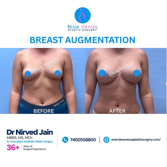 A refined approach to breast augmentation is about enhancing proportions while keeping the overall a