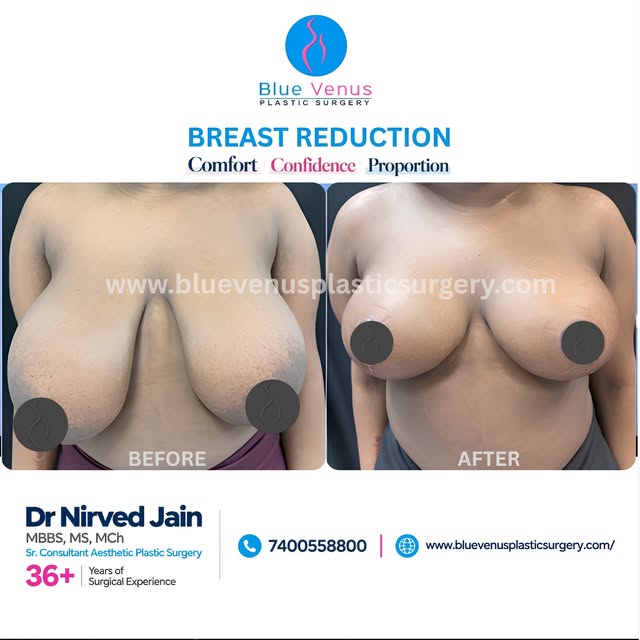 Comfort. Confidence. Proportion. 🤍

Breast reduction surgery can be considered when breast size fee