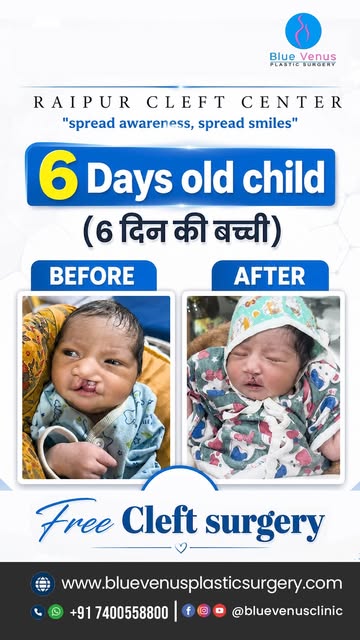 🤍 सिर्फ 6 दिन की उम्र। और एक नई शुरुआत की ओर पहला कदम।

इस नन्ही बच्ची की journey Cleft Lip Treatme