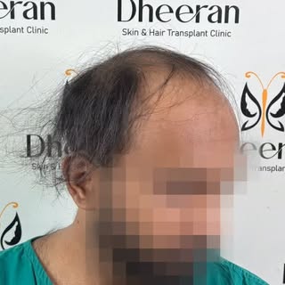 From Sri Lanka 🇱🇰 to Coimbatore 🇮🇳 for a Hair Transformation!

Choosing the right clinic is just