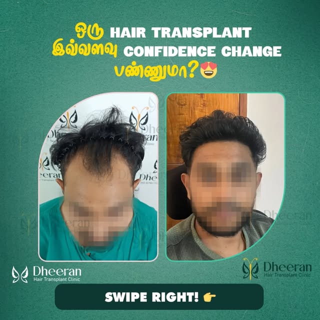 ஒரு Hair Transplant… Confidence-ஐயே மாற்றிடுமா? 😍🔥

Hairline குறைவு, thinning, baldness — இவை appe