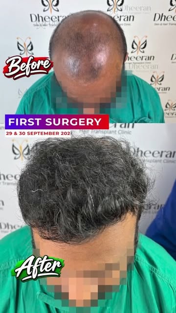 Sometimes the best transformations begin with a "No." ✨
This patient was told hair transplant wasn't