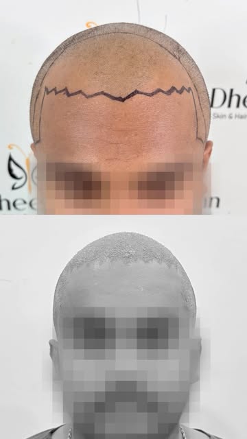 From CHENNAI → COIMBATORE for a NATURAL HAIRLINE! 

Why did he travel from Chennai for his hair tran
