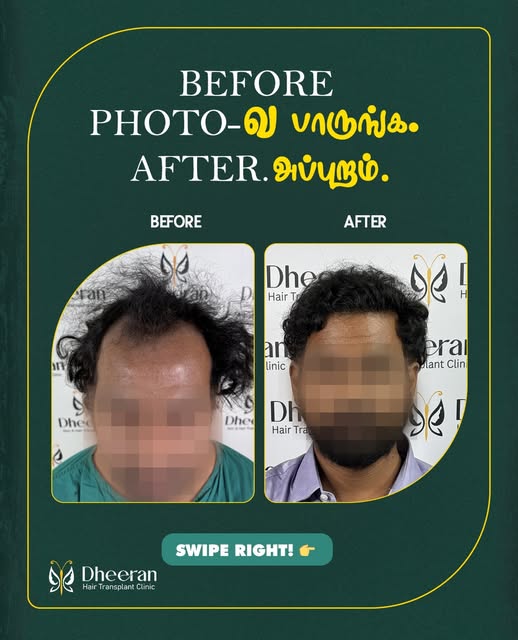 A visible transformation starts with the right planning, hairline design and graft placement.

This 