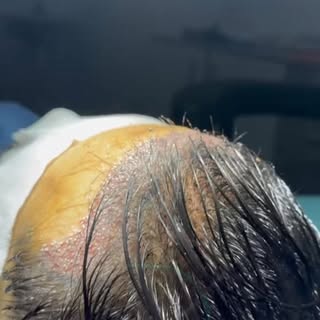Mit der DHI-Haartransplantationstechnik ist eine Haartransplantation möglich, ohne dass Ihnen alle H