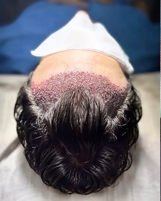DHI Haartransplantation in Mannheim

Langjährige Erfahrung in der Haartransplantation – direkt in Ma