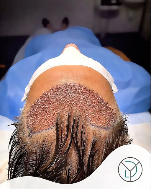 Haartransplantation in Mannheim – Erfahrung, Präzision und medizinische Betreuung auf hohem Niveau.
